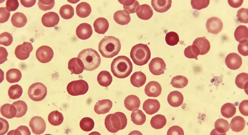 اختلالات گلبول قرمز (Red Blood Cell Disorders)